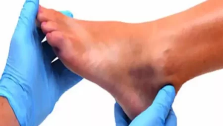 Ayak Parmağındaki Yaralanmalar Kangren Yapabilir