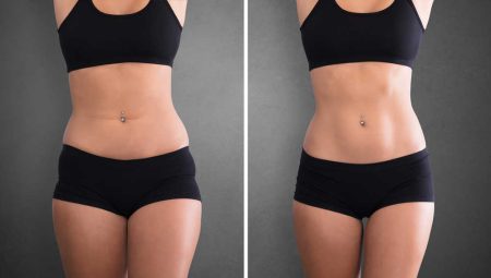 Bölgesel Zayıflama (İncelme) Nedir?